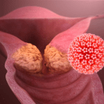 Tuore, Vaccino e Papillomavirus: le nuove evidenze scientifiche