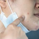 Coronavirus, mascherina compatibile con malattie della pelle