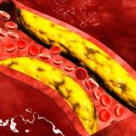 Rischio cardiovascolare, alirocumab riduce il colesterolo delle lipoproteine non ad alta densità