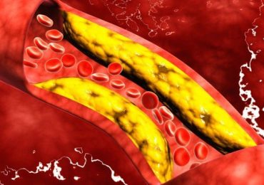 Rischio cardiovascolare, alirocumab riduce il colesterolo delle lipoproteine non ad alta densità