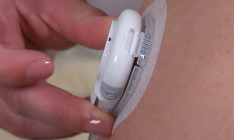 Diabete, premio Innovation of the Year 2020 a una micropump senza catetere