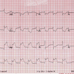 IMA: Escherichia Coli come fattore di rischio 1