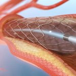 Cateterismo cardiaco