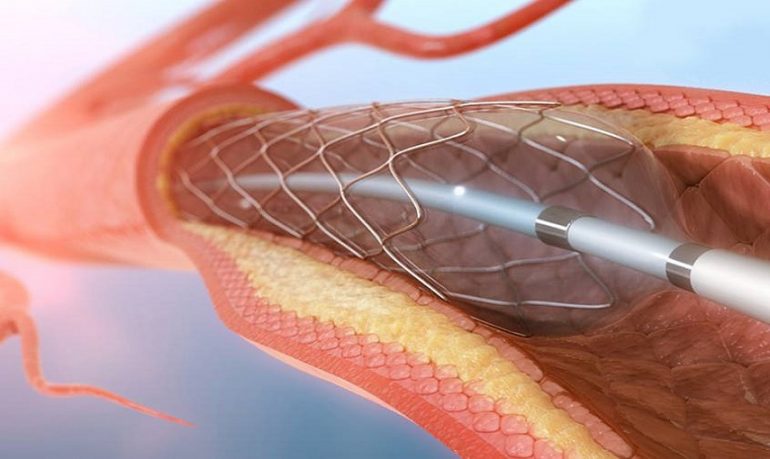 Infarto durante angioplastica: ticagrelor non superiore a clopidogrel nel ridurre il rischio