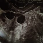 Sindrome dell’ovaio policistico e insulino-resistenza