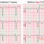 Lettura ECG. La Sindrome di Wellens