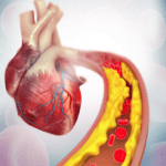 Malattia cardiovascolare aterosclerotica: evolocumab+statina riducono futura rivascolarizzazione