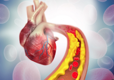 Malattia cardiovascolare aterosclerotica: evolocumab+statina riducono futura rivascolarizzazione