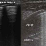 Polmone ed approccio diagnostico: l ‘ecografia