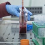 Sclerosi multipla aggressiva: efficace il trapianto autologo di cellule staminali ematopoietiche