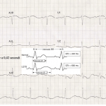 Sindrome del QT lungo e terapia ibrida RNA/DNA. I risultati