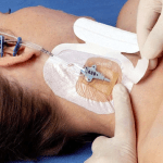 Dalla letteratura un bundle in 10 punti per la medicazione degli accessi vascolari centrali 1