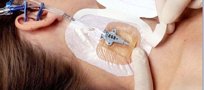 Dalla letteratura un bundle in 10 punti per la medicazione degli accessi vascolari centrali 1