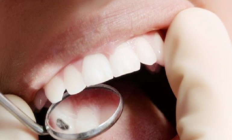 Amalgama dentale, adottato il Piano nazionale per l’eliminazione
