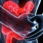 Colite ulcerosa moderata-grave: conferme di efficacia e sicurezza per upadacitinib