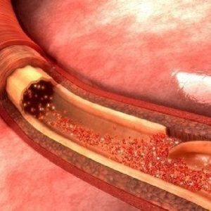 Dissecazione aortica: conosciamola meglio