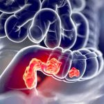 Scozia, allo studio sistema per rimuovere tumori senza ledere tessuti circostanti