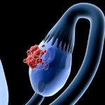Carcinoma ovarico invasivo, compreso il meccanismo base delle metastasi