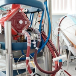 ECMO: un possibile salvavita contro il Covid-19 1