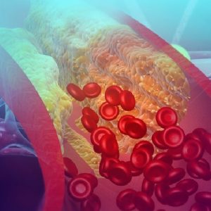 Ipercolesterolemia: combinazione di acido bempedoico, ezetimibe e atorvastatina riduce LDL
