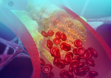 Ipercolesterolemia: combinazione di acido bempedoico, ezetimibe e atorvastatina riduce LDL