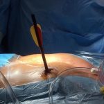 Torino, intervento salva la vita a uomo con cuore e polmone trapassato da una freccia