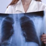 Fibrosi polmonare: tutto quello che c'è da sapere