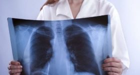Fibrosi polmonare: tutto quello che c'è da sapere