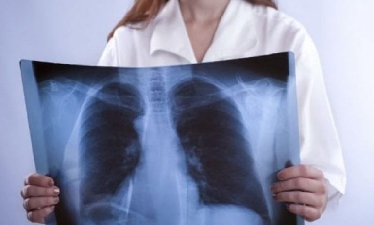 Fibrosi polmonare: tutto quello che c'è da sapere