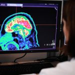 La fibrillazione atriale provoca declino cognitivo e demenza