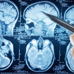 Pacemaker impiantabile contro il Parkinson: cambio di passo nella neurostimolazione