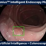 Polipi del colon-retto, Fda autorizza il primo sistema di intelligenza artificiale per identificarli