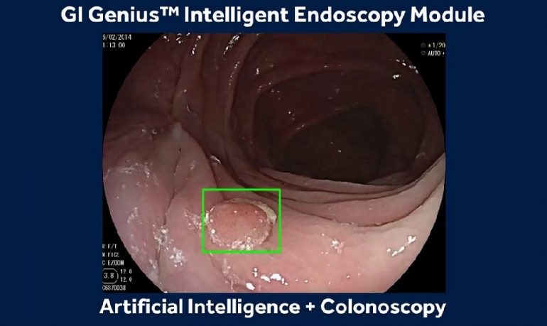 Polipi del colon-retto, Fda autorizza il primo sistema di intelligenza artificiale per identificarli