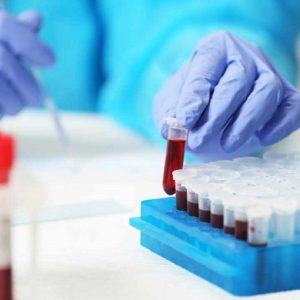 Tumori: predire l'evoluzione in malattia metastatica con un prelievo di sangue