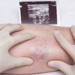 Vaccino AstraZeneca e casi di trombosi/trombocitopenia: lo studio