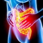 Colite ulcerosa: tutto quello che c'è da sapere