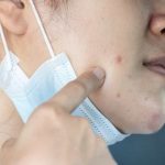 Coronavirus e problemi alla pelle: i consigli della SIDeMaST per scongiurare l'effetto "Covid face"