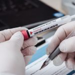 Coronavirus, gli anticorpi durano almeno 8 mesi dopo la diagnosi