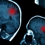 Gliomi, scoperti nuovi bersagli genetici per contrastare la crescita tumorale
