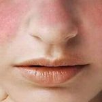 Lupus: l'importanza di ascoltare i pazienti
