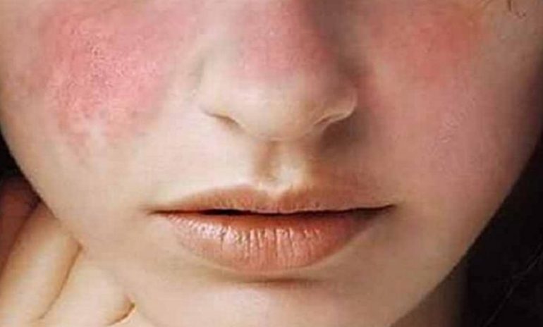 Lupus: l'importanza di ascoltare i pazienti