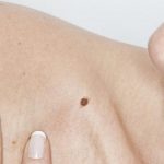 Melanoma: l'importanza dell'autoesame