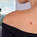 Il melanoma metastatico e l’enzima in grado di controllarlo
