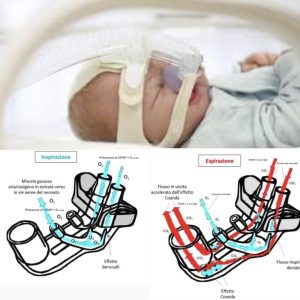 Infant Flow: l’applicazione dell’effetto ‘Conada’ nella ventilazione non invasiva del neonato 1