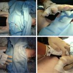 Novel adhesive glove device