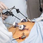 Obesità: il trattamento con chirurgia bariatrica