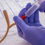 Ridotto flusso urinario negli over 50: il collegamento con la stenosi uretrale