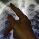 Tubercolosi multiresistente: buoni risultati dall'impiego di amikacina a dosi ridotte e con monitoraggio terapeutico