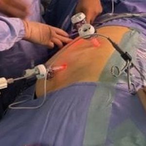 Tumore del rene, crioablazione laparoscopica eseguita a Taranto