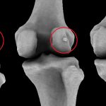 Fabella: L’Osso Primordiale Scomparso Con L’Evoluzione